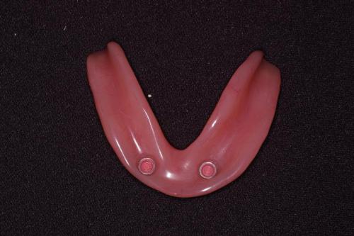 Lower Denture with Locators