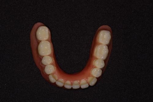 Lower Denture (Occlusal View)