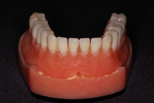 Lower Denture on Model