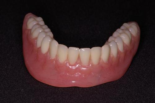 Lower Denture with Locator