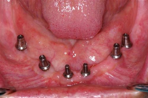 Implants with Stock Abutments for Supporting a Fixed Denture