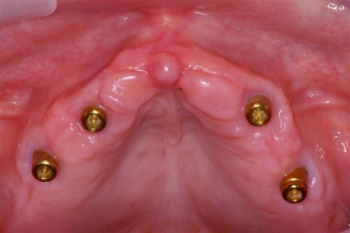 Implants with Locatorabutments to Support an Overdenture