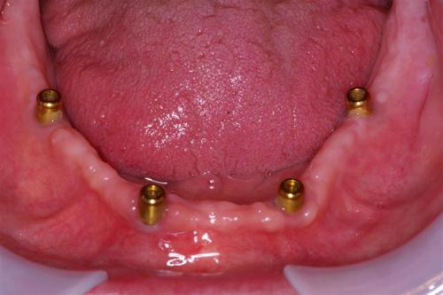Locator Abutments in a Lower Edentulous Arch