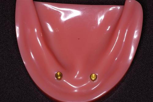 Locator Abutments in Lower Edentulous Model