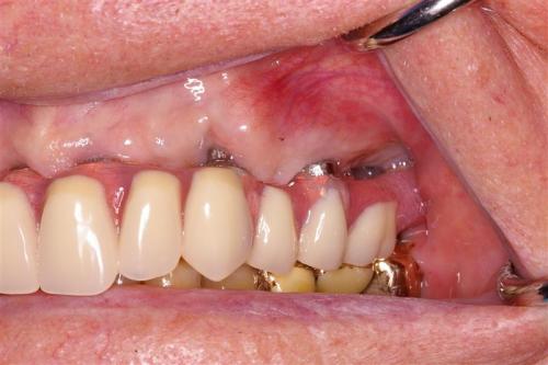 Left Side View of Fixed Hybrid Overdenture