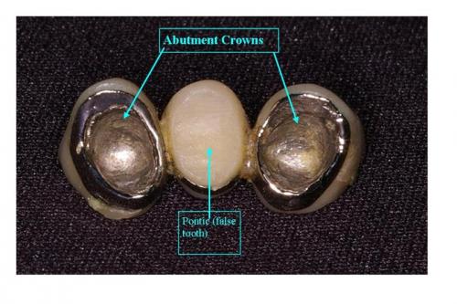 Internal View of Three Tooth PFM Bridge