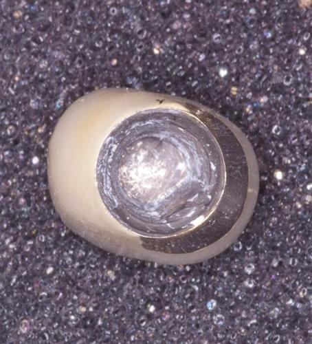 Internal View of a Porcelain Fused to Metal Crown