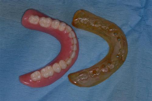Lower Denture and Replica Surgical Guide