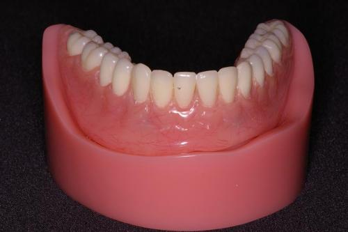 Lower Denture Attached with Locators