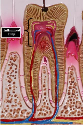 Inflammed Pulp