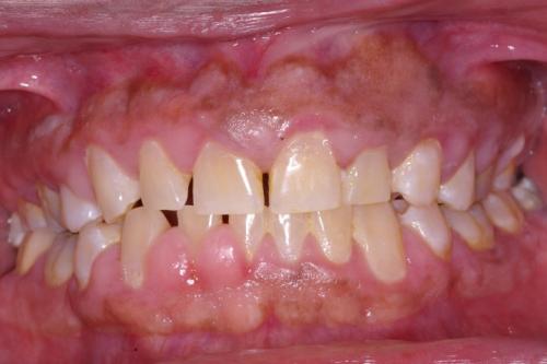 Laser Treatment (Before)