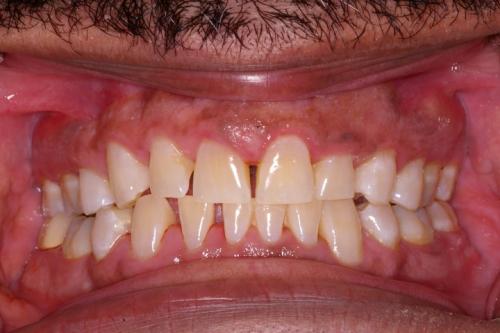 Laser Treatment (After)