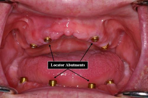 Locator Abutment Upper and Lower