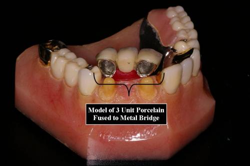 Model of 3 Unit Porcelain Fused to Metal Bridge