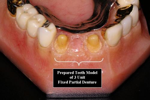 Prepared Teeth Model for 3 Unit Fixed Partial Denture